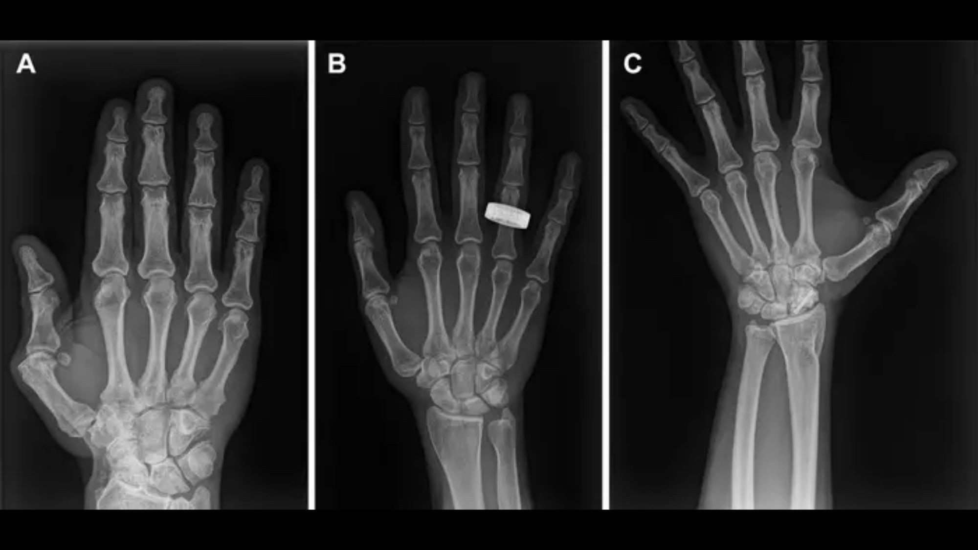 First-Ever X-Rays Taken in Orbit Pave Way for Lunar Medical Care